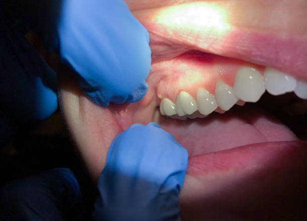 Best Emergency Dental Care for Abscessed Tooth in Henagar, AL